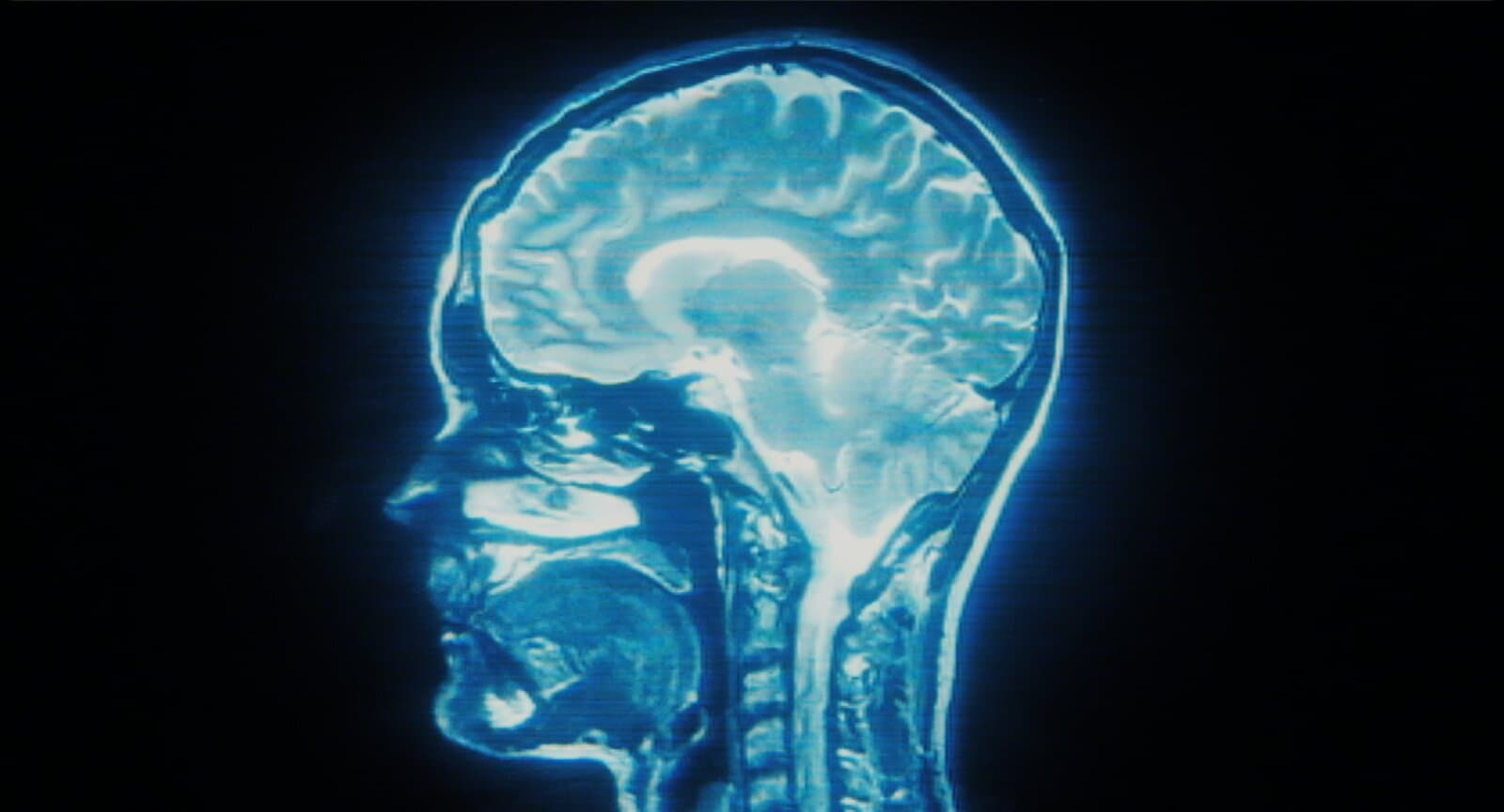 Imagem de ressonância magnética exibida numa tela antiga: um corte lateral de cabeça humana em azul e branco, mostrando o cérebro, a face e o início da coluna, com linhas horizontais de varredura sobre a imagem.
